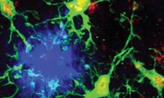 重磅：科学家找到阿尔茨海默病的“内置刹车系统”